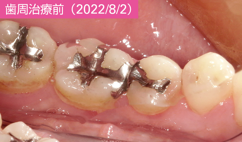 [写真] 歯周治療前（2022/8/2）