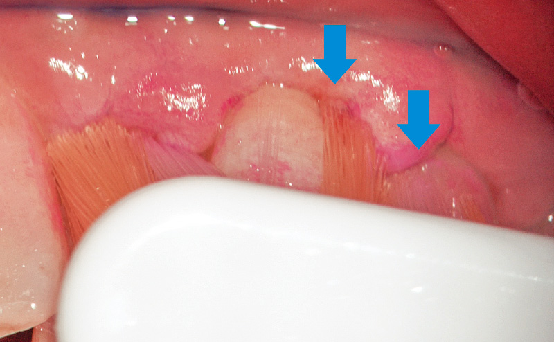 [写真] 歯周病により歯肉が腫脹している部位にCheck-Up歯ブラシを使用し、バス法を行っている様子