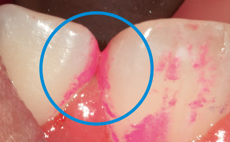 [写真] 矯正治療に伴うIPRやディスキングによりコンタクトにわずかな隙間が生じ、隅角と歯間部にプラークが付着している
