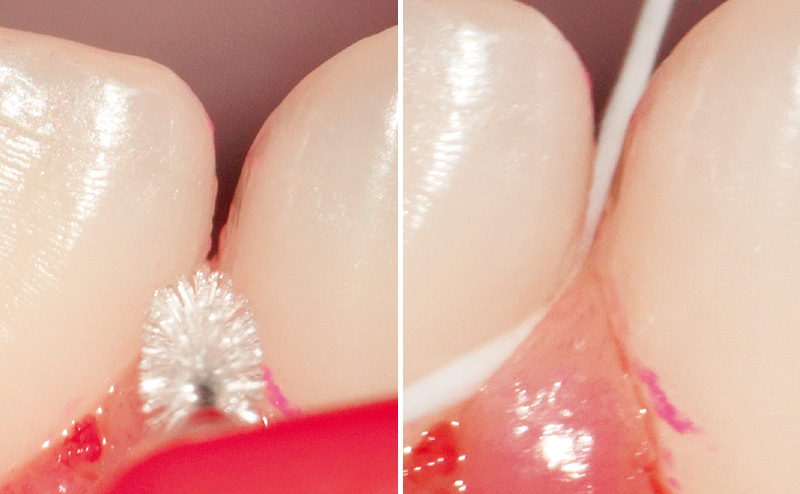 [写真] 隅角と歯間部に4Sの歯間ブラシを使用するが、隙間が狭く、歯間ブラシが挿入できない（左）。同部にフロスを通してみるが、隙間が広くテクニックが必要である（右）