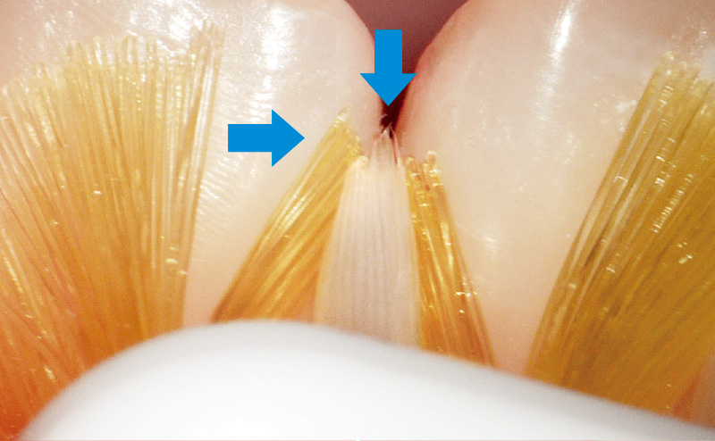 [写真] 隅角と歯間部にCheck-Up歯ブラシを使用している様子
