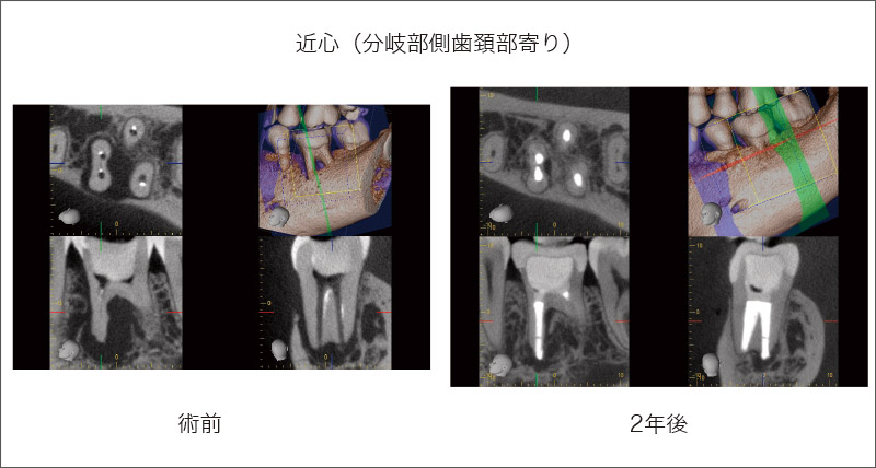 [写真] 根尖病変、穿孔、歯根破折を疑う複合要因を有する治療