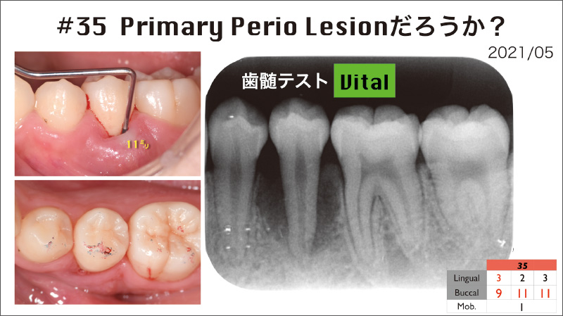 [写真] 中心結節の破折によるPrimary Endoを疑ったが認められず