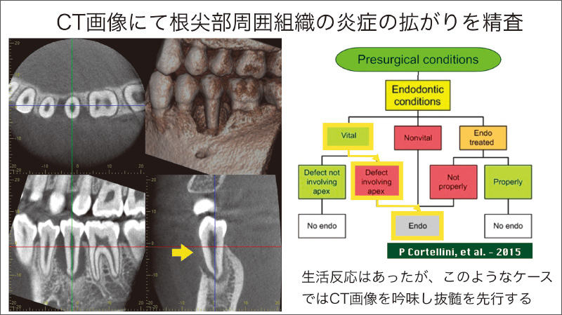 [写真] CT画像では頰側に限局した根尖に及ぶ骨破壊を認める