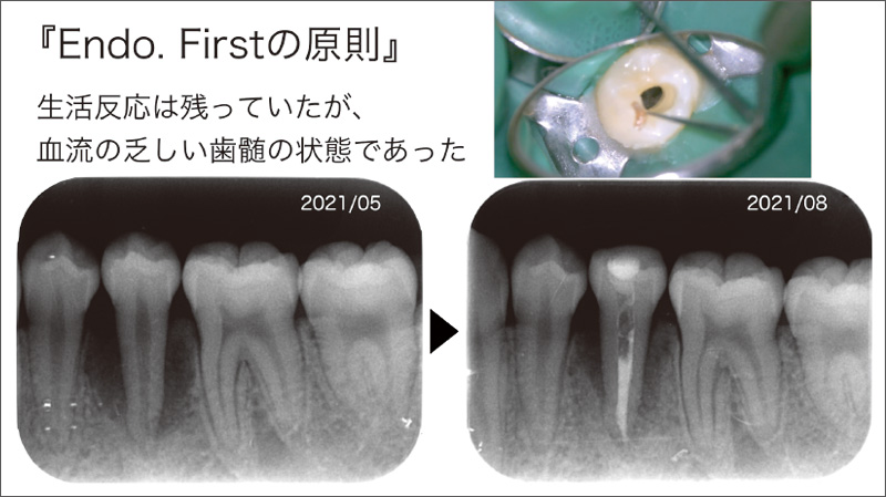 [写真] Endo Firstの原則に準じて治療を行い、3か月間根尖周囲組織の炎症の消退を待った