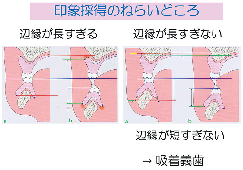 [図] 印象採得のねらいどころ