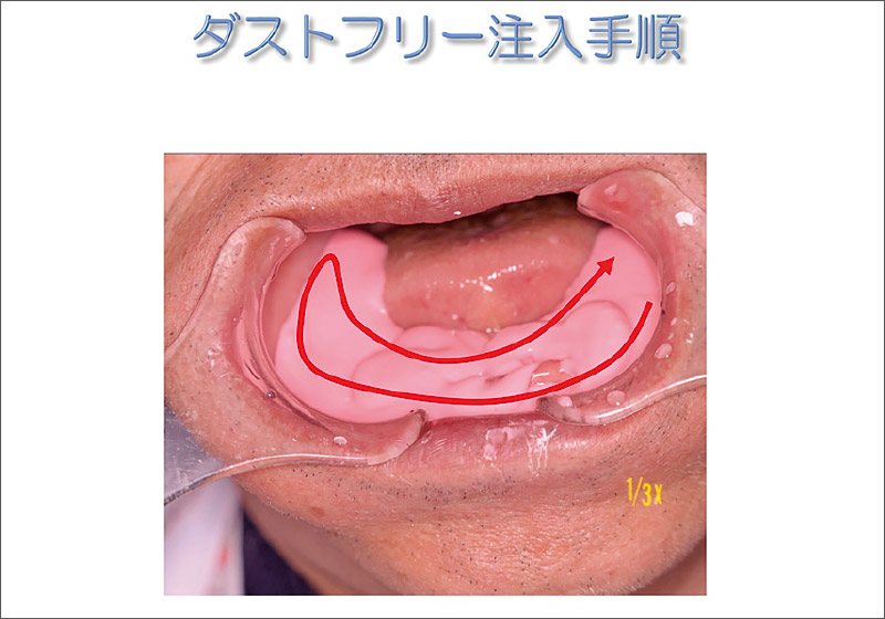 [図] ダストフリー注入手順
