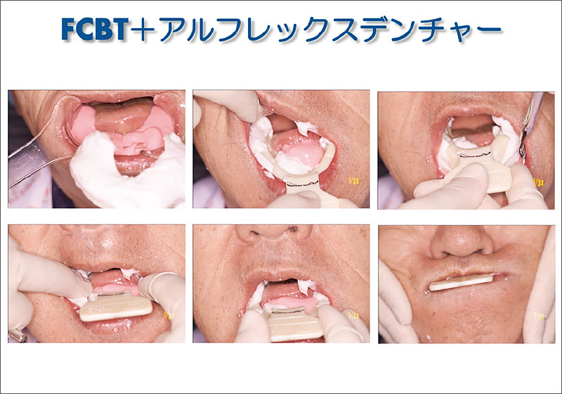 [図] FCBT ＋ アルフレックスデンチャー