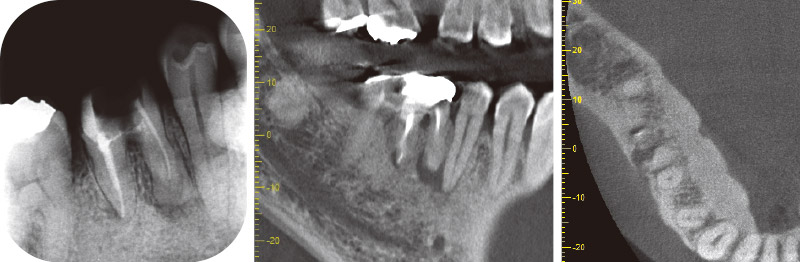 [写真] 初診時のデンタルX線写真とCBCT