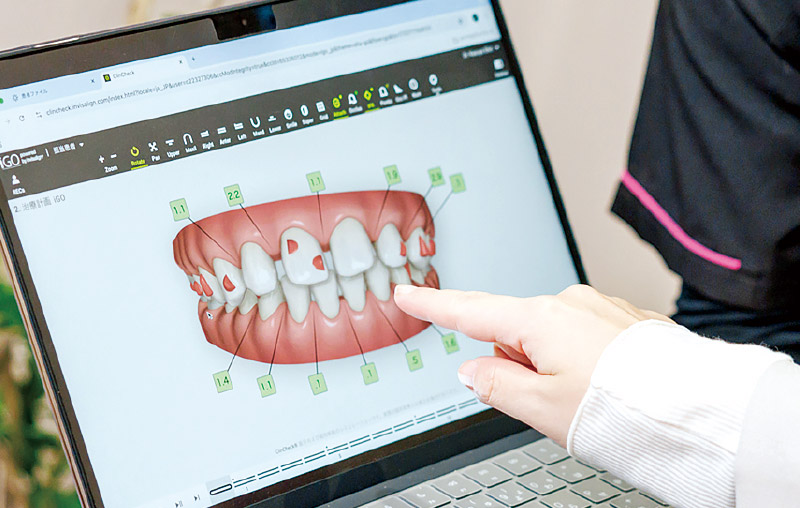 [写真] クリンチェック治療計画では治療前と治療後の口腔内を3Dシミュレーションで再現
