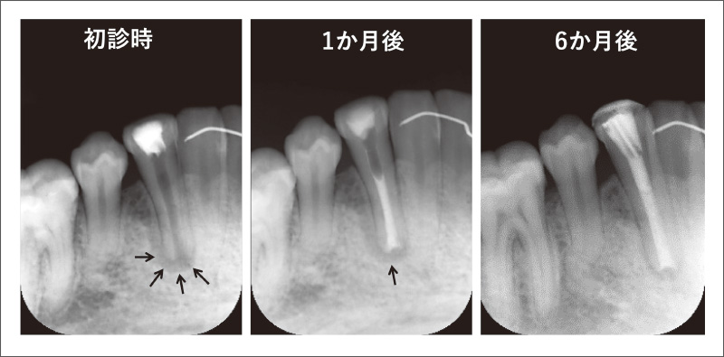 [写真] 根尖孔が開大した根管への根管充填（27歳女性）
