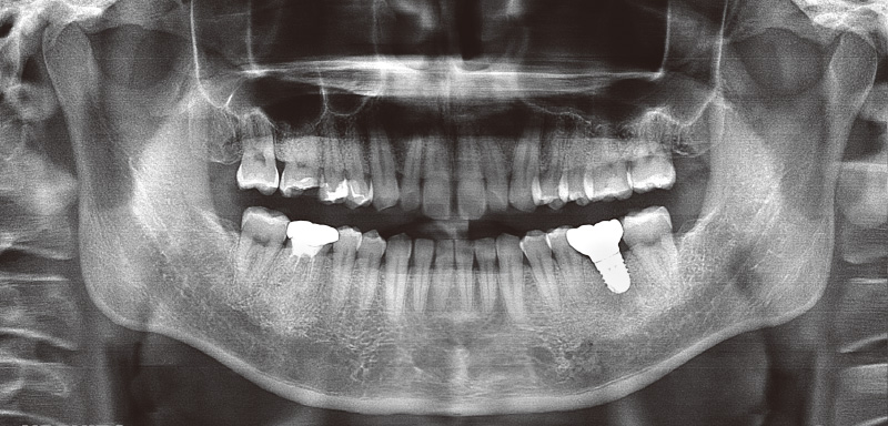 [写真] 補綴装置セット後のパノラマX線写真