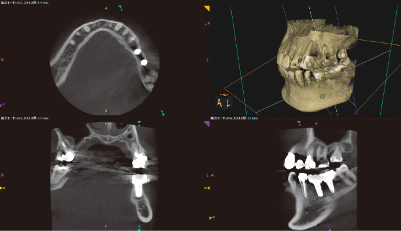 [写真] 骨レベルの状態確認のためCBCT撮影