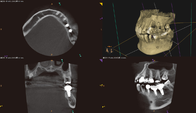 [写真] 骨レベルの状態確認のためCBCT撮影