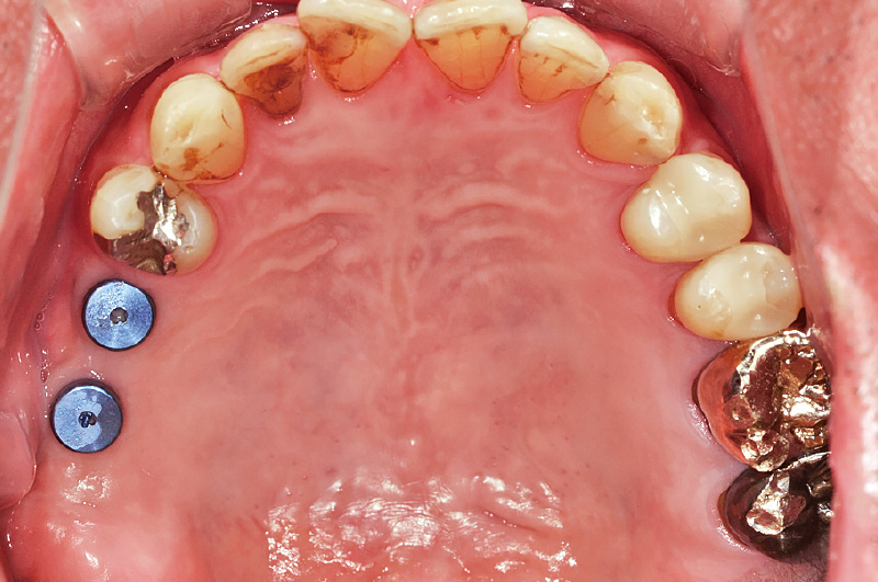 [写真] 2次手術前