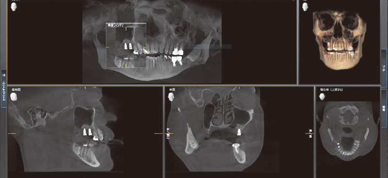 [写真] CT画像よりサイナスリフト後、インプラント埋入を行うに十分な骨量が確保されている状態を確認できる