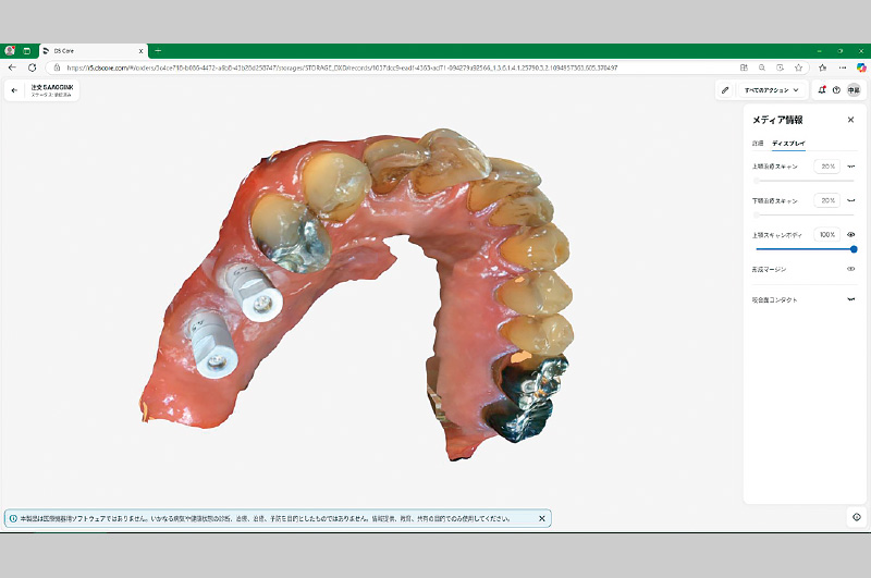 [写真] デジタル印象採得
