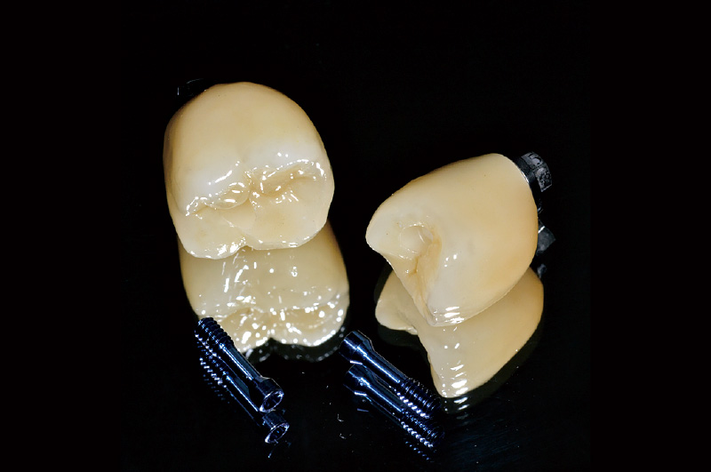 [写真] ジルコニア製上部構造