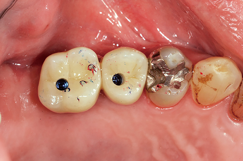 [写真] 試適と咬合調整