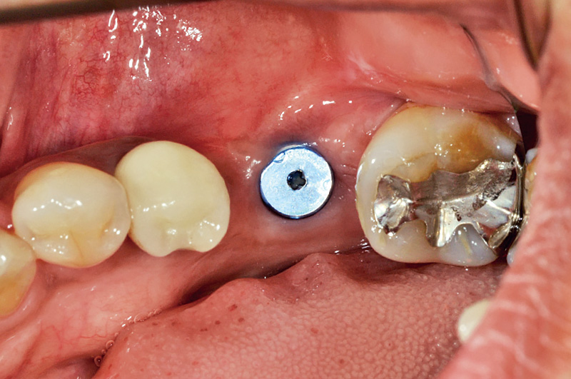 [写真] 症例② 2次手術前