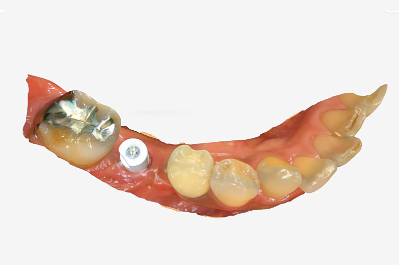 [写真] デジタル印象採得