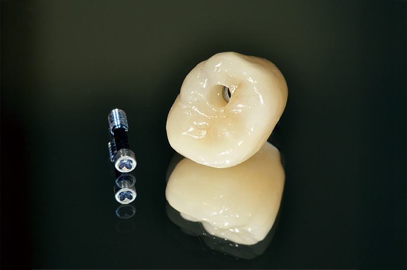 [写真] 二ケイ酸リチウム製上部構造