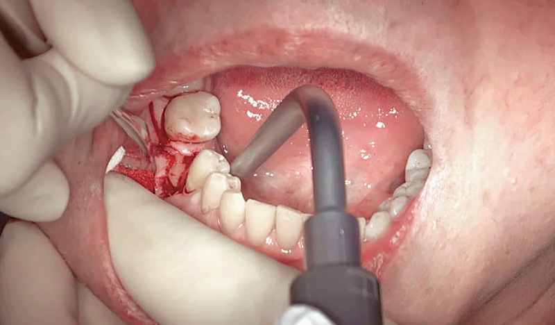 [写真] インプラント埋入部位の歯肉を切開