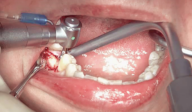 [写真] 顎骨を露出させ、ドリリング後にインプラントを埋入