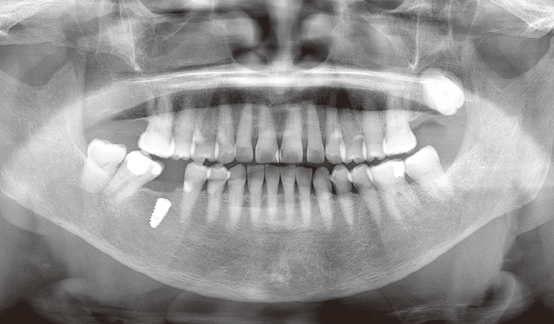 [写真] 一次手術を終えた現在の状態