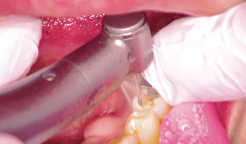 [写真] メタルインレーを除去