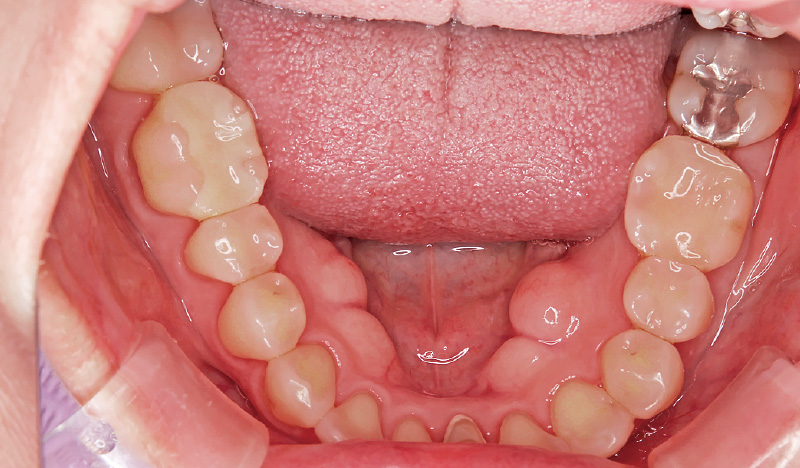 [写真] 現在の口腔内