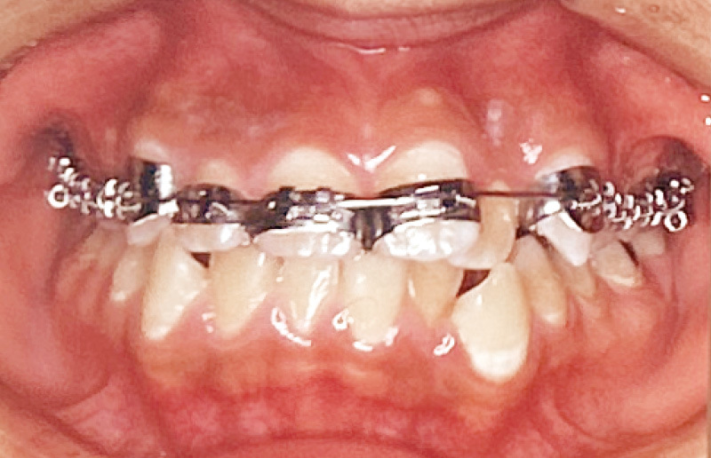 [写真] 全歯バンド装着法