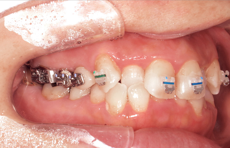 [写真] 多様な修復材料に対するブラケット接着例：47歳女性