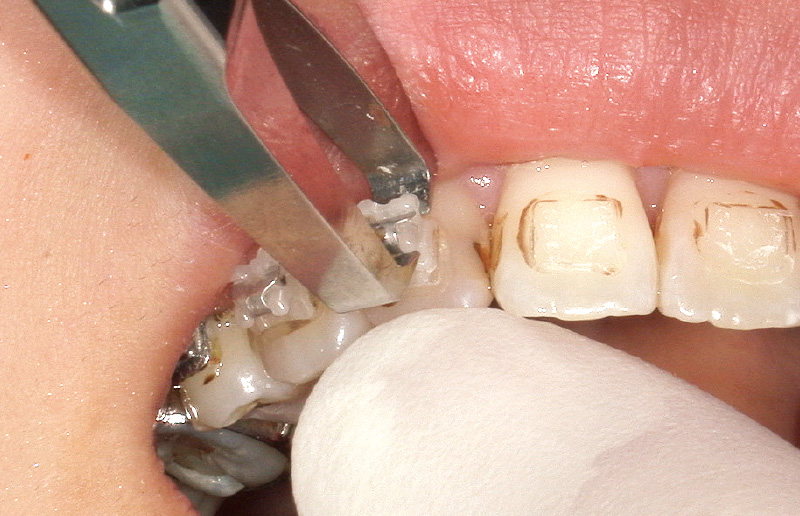 [写真] デボンド時の指による歯牙動揺の抑制法：筆者のデボンド時の様子