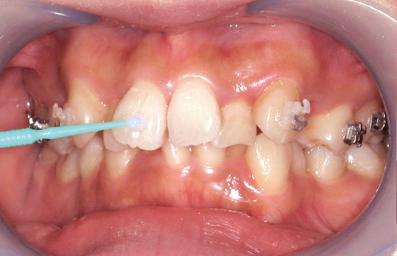 [写真] 歯面への「ティースプライマー」の塗布