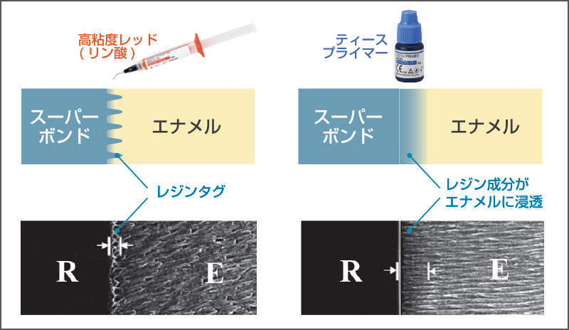 [図] エナメル質の表面処理材の違いについて