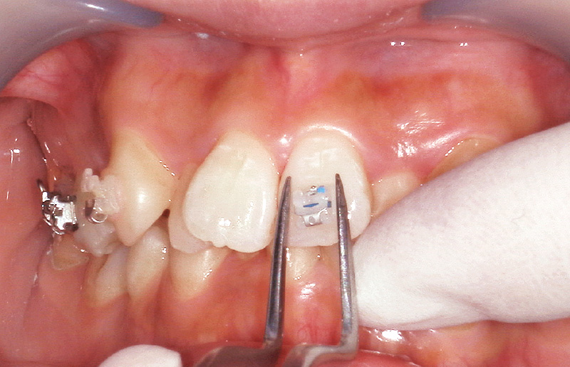 [写真] 慎重にブラケットを歯のFAポイントに位置付ける