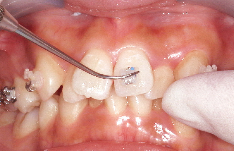 [写真] 探針で位置を微調整後、圧接