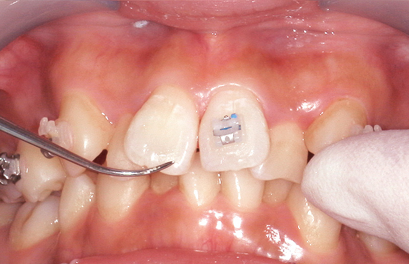 [写真] 探針で余剰レジンを除去