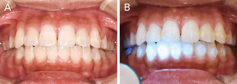 [写真] デボンド直後のレジン残留状況比較
