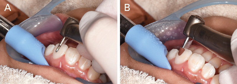 [写真] 「ボンドフィルSBⅡ」除去の流れ