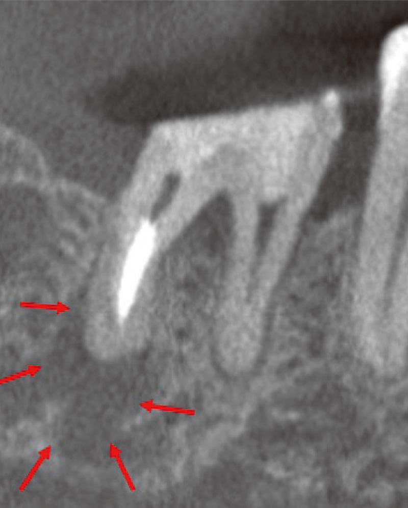[写真] 高周波通電（HFC）後、根管充填