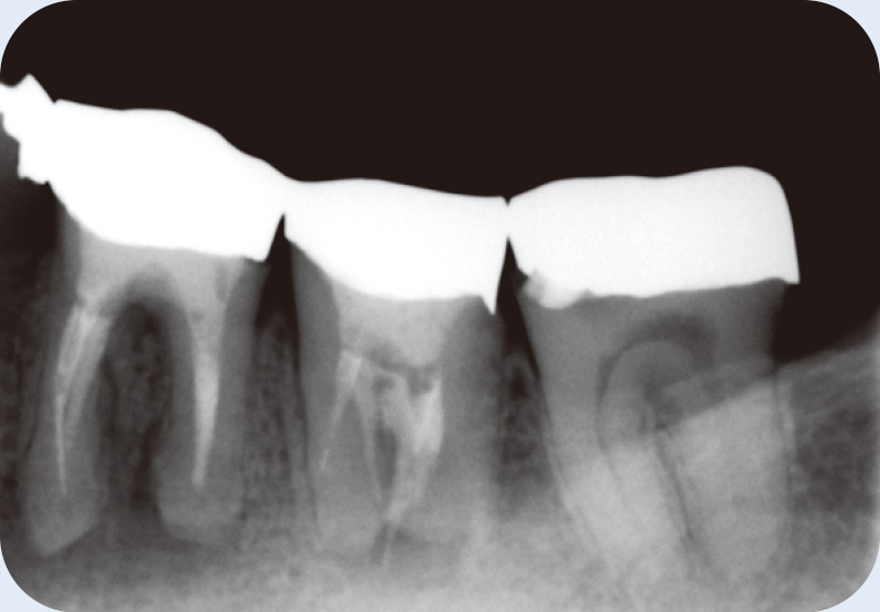 [写真] 46歳男性 ンタルX線にてオーバー根充を認める