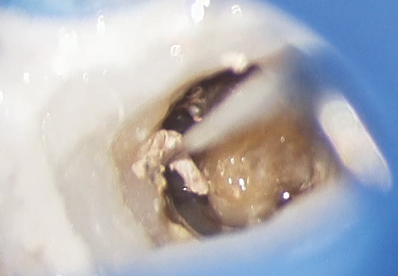 [写真] 根管内から一塊で取り出したガッタパーチャ