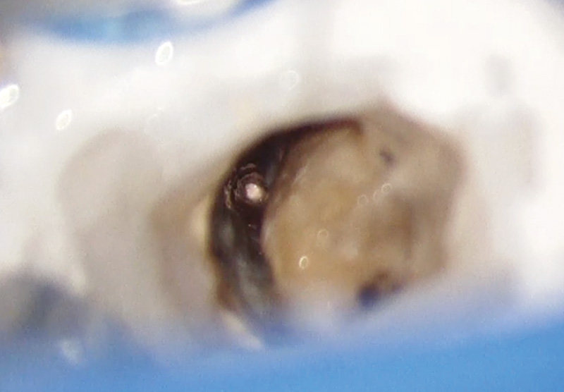 [写真] 根尖孔外に残遺したガッタパーチャ