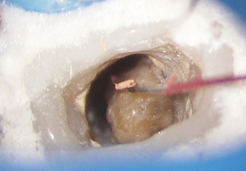 [写真] 根尖孔外から取り除いたガッタパーチャ