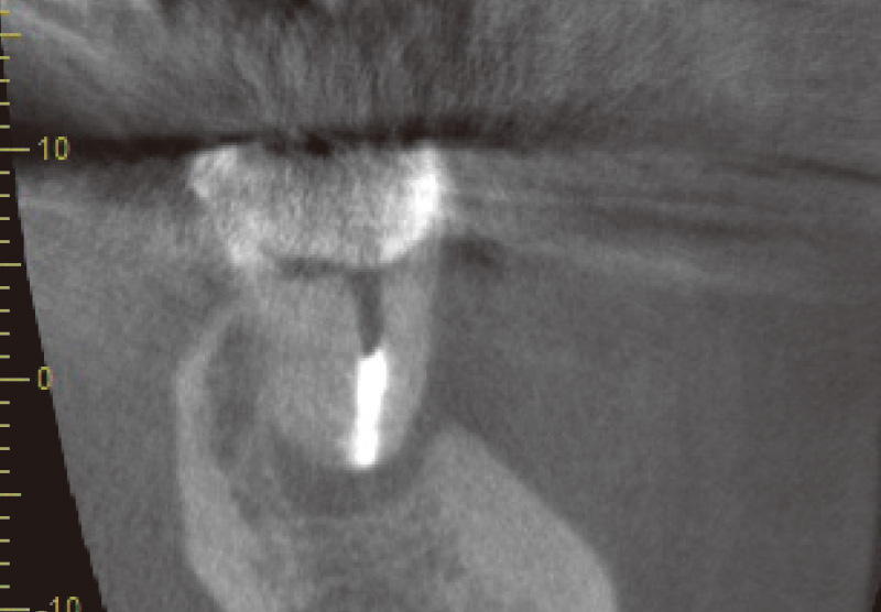 [写真] MTAにて根管充填後のCBCT画像
