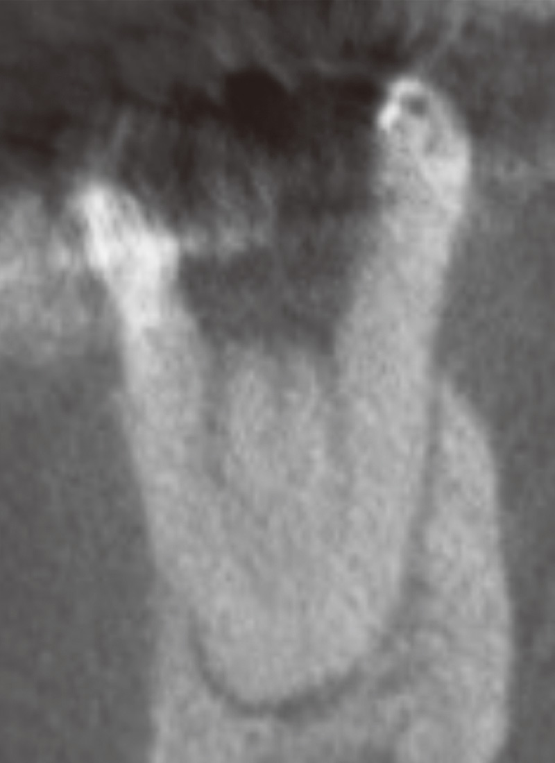 [写真] 前頭断（近心根）