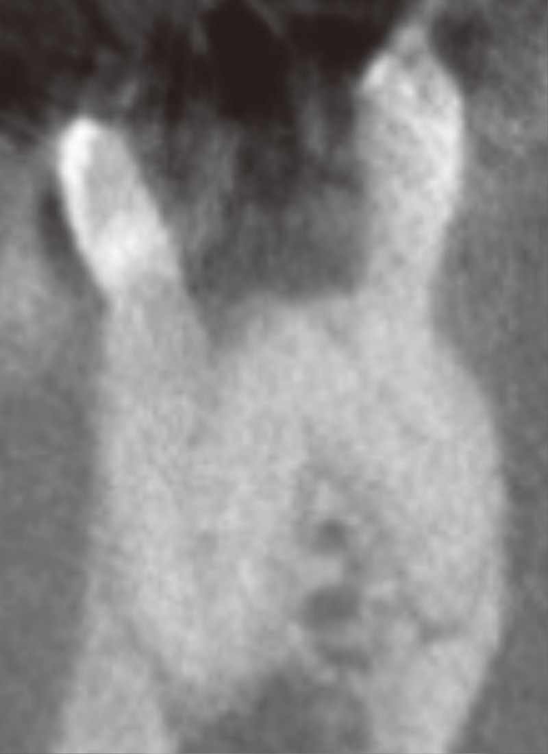 [写真] 前頭断（遠心根）