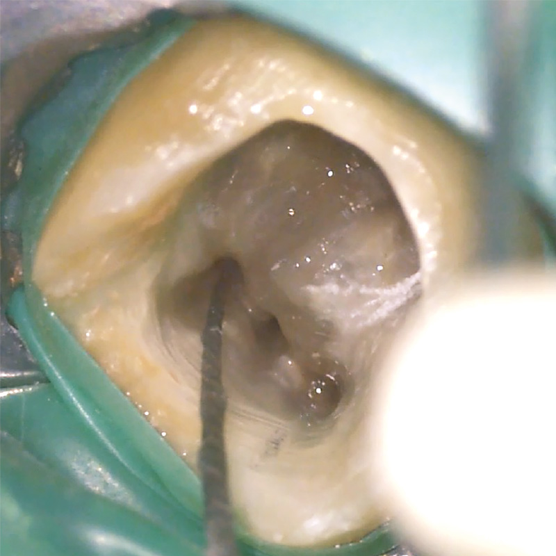 [写真] 電極挿入時